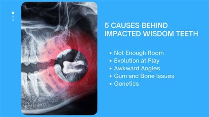 Why is my wisdom tooth decaying?