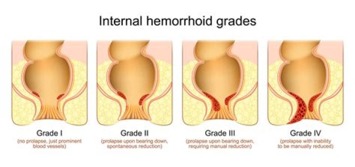 Why won't my hemorrhoid go away?