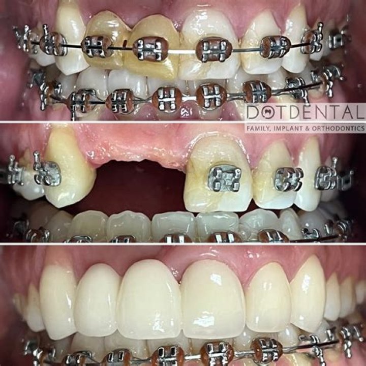 Why would braces be medically necessary?