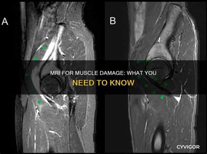 Will an MRI show muscle damage?