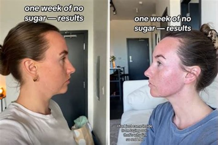 Will cutting out sugar help acne?