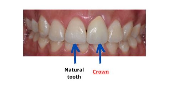 Will my crown match my teeth?