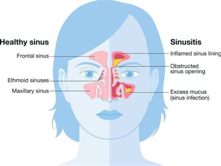 Will sinus infection go away on OWN?