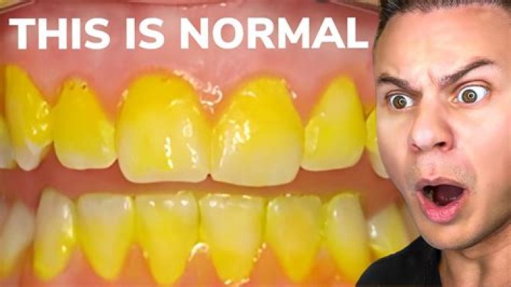 Will yellow teeth ever become white?